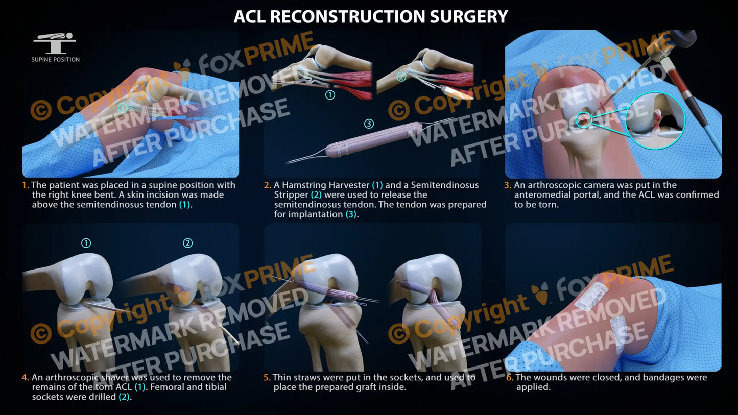 Acl Repair Right Single Use / Light Still Shot