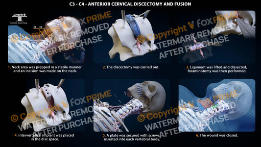 Anterior Cervical Discectomy And Fusion Left C3-C4 Single Use / Male Light Still Shot