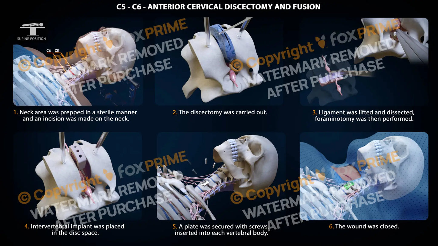 Anterior Cervical Discectomy And Fusion Left C5-C6 Single Use / Female Light Still Shot