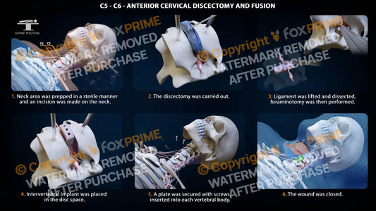 Anterior Cervical Discectomy And Fusion Left C5-C6 Single Use / Female Light Still Shot
