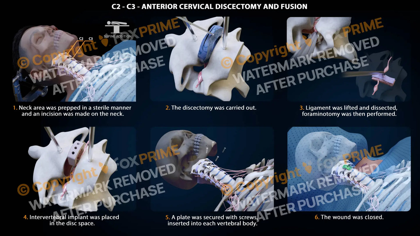 Anterior Cervical Discectomy And Fusion Right C2-C3 Single Use / Male Light Still Shot