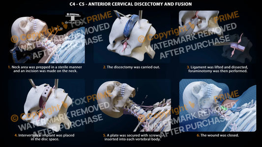 Anterior Cervical Discectomy And Fusion Right C4-C5 Single Use / Female Light Still Shot