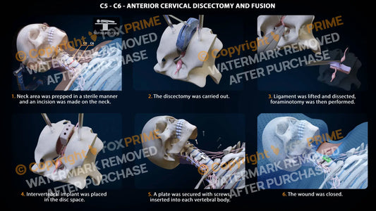Anterior Cervical Discectomy And Fusion Right C5-C6 Single Use / Female Light Still Shot
