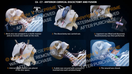 Anterior Cervical Discectomy And Fusion Right C6-C7 Single Use / Female Light Still Shot