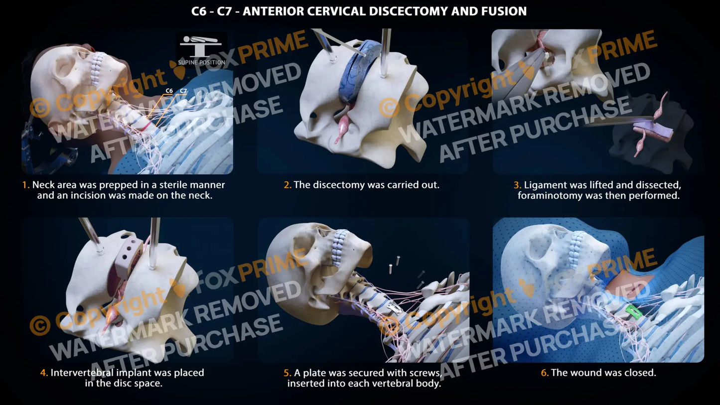 Anterior Cervical Discectomy And Fusion Right C6-C7 Single Use / Male Light Still Shot