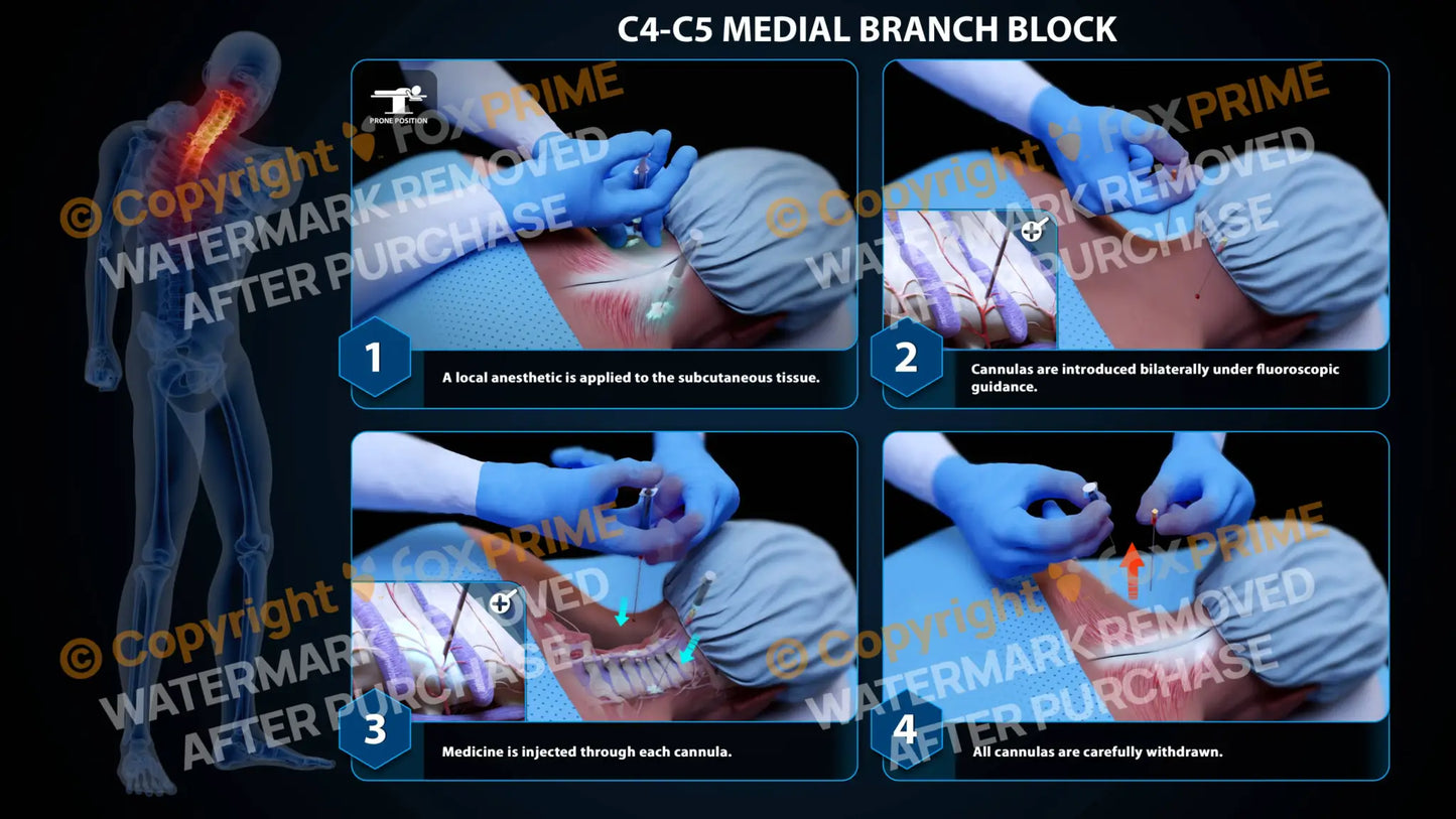 Bilateral Medial Branch Block C4-C5 - Still Shot
