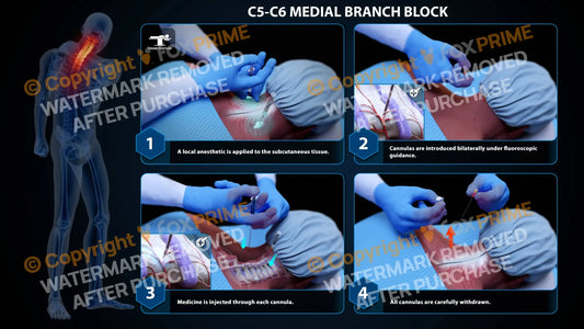 Bilateral Medial Branch Block C5-C6 - Still Shot
