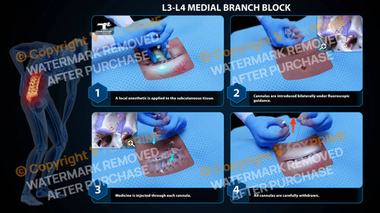 Bilateral Medial Branch Block L3-L4 Still Shot