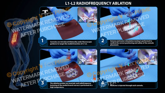 Bilateral Radiofrequency Ablation L1-L2 (PowerPoint) PowerPoint