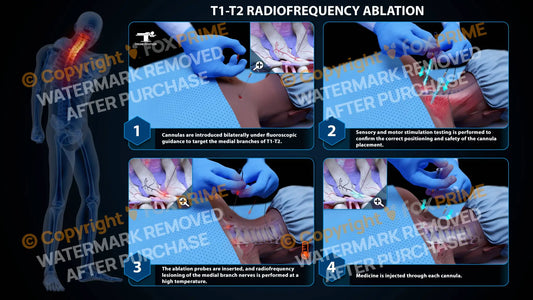 Bilateral Radiofrequency Ablation T1-T2 (PowerPoint) - PowerPoint