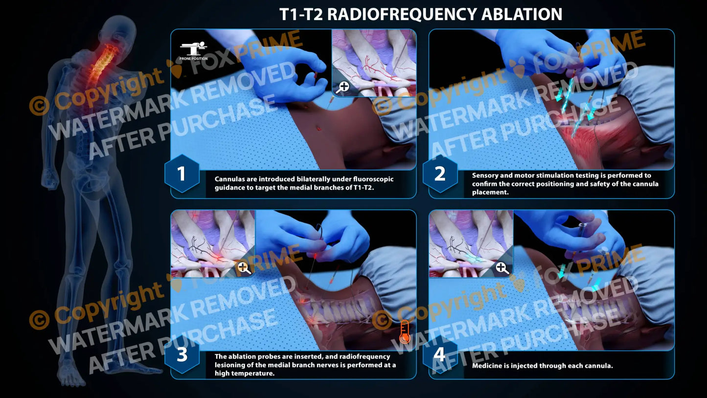 Bilateral Radiofrequency Ablation T1-T2 - Still Shot