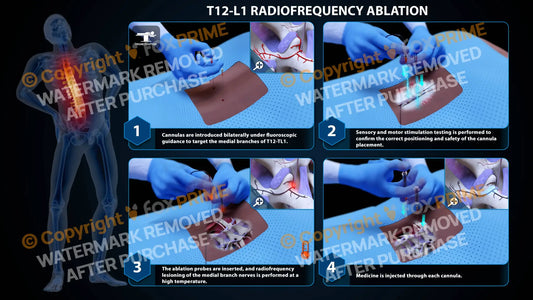 Bilateral Radiofrequency Ablation T12-L1 Still Shot
