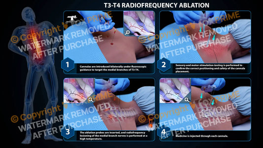 Bilateral Radiofrequency Ablation T3-T4 (PowerPoint) - PowerPoint