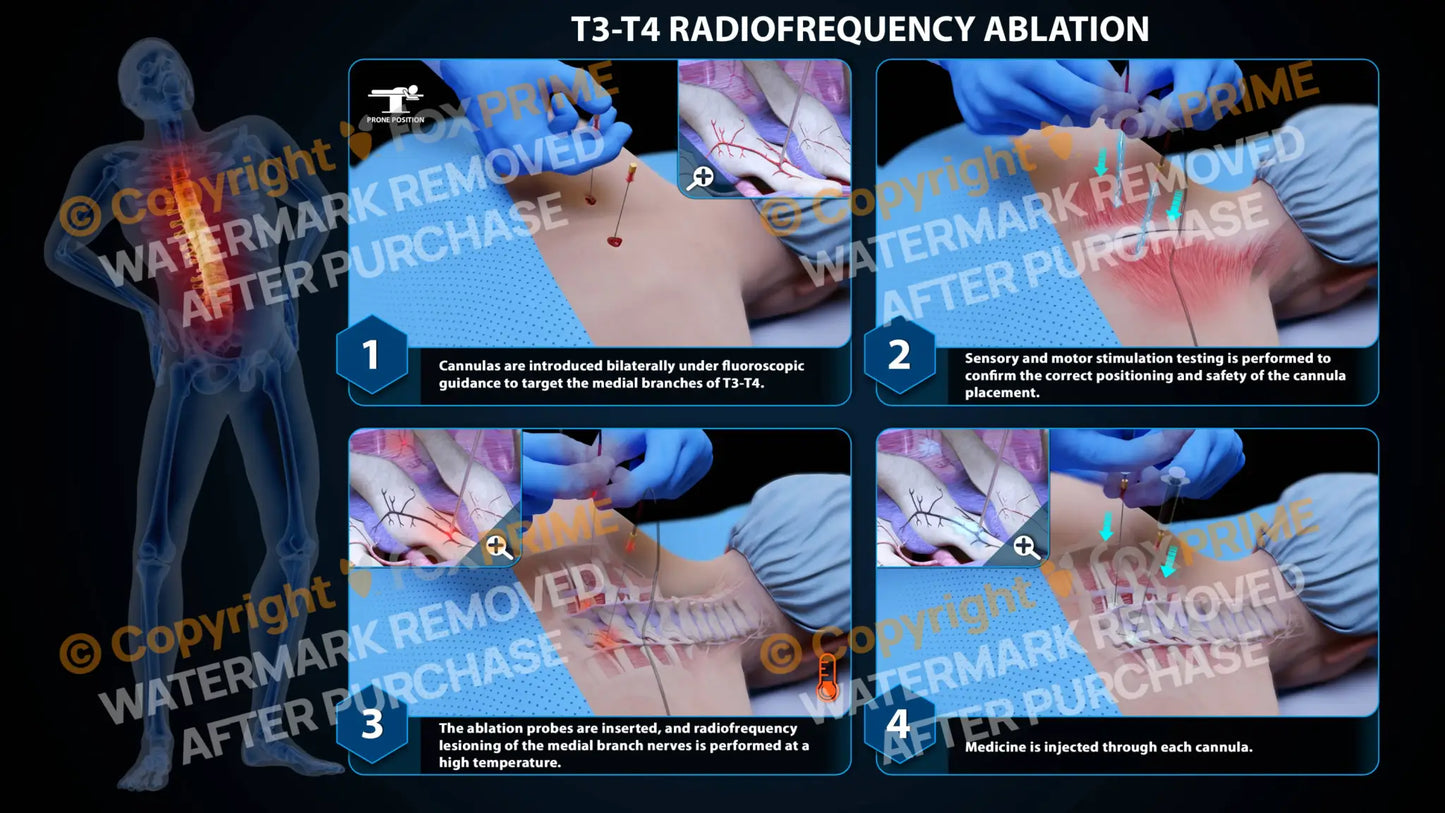 Bilateral Radiofrequency Ablation T3-T4 - Still Shot
