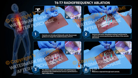Bilateral Radiofrequency Ablation T6-T7 (PowerPoint) PowerPoint