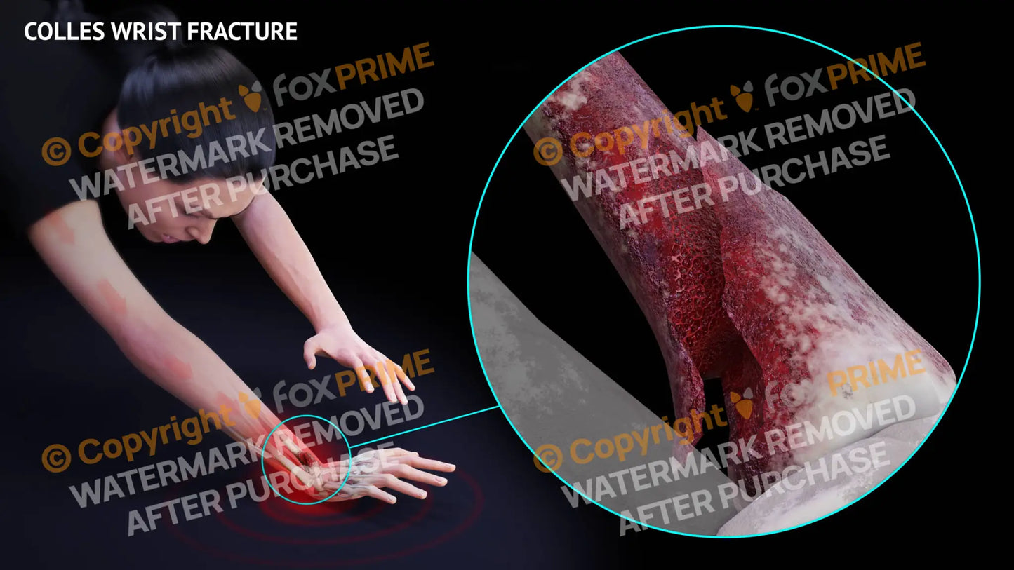 Colles Wrist Fracture Single Use / Female / Light Still Shot