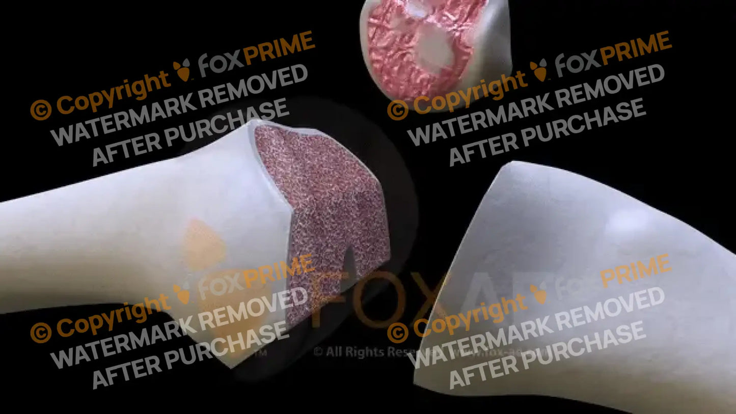 CUSTOM KNEE ORIF (Open Reduction Internal Fixation) Surgery / Animation