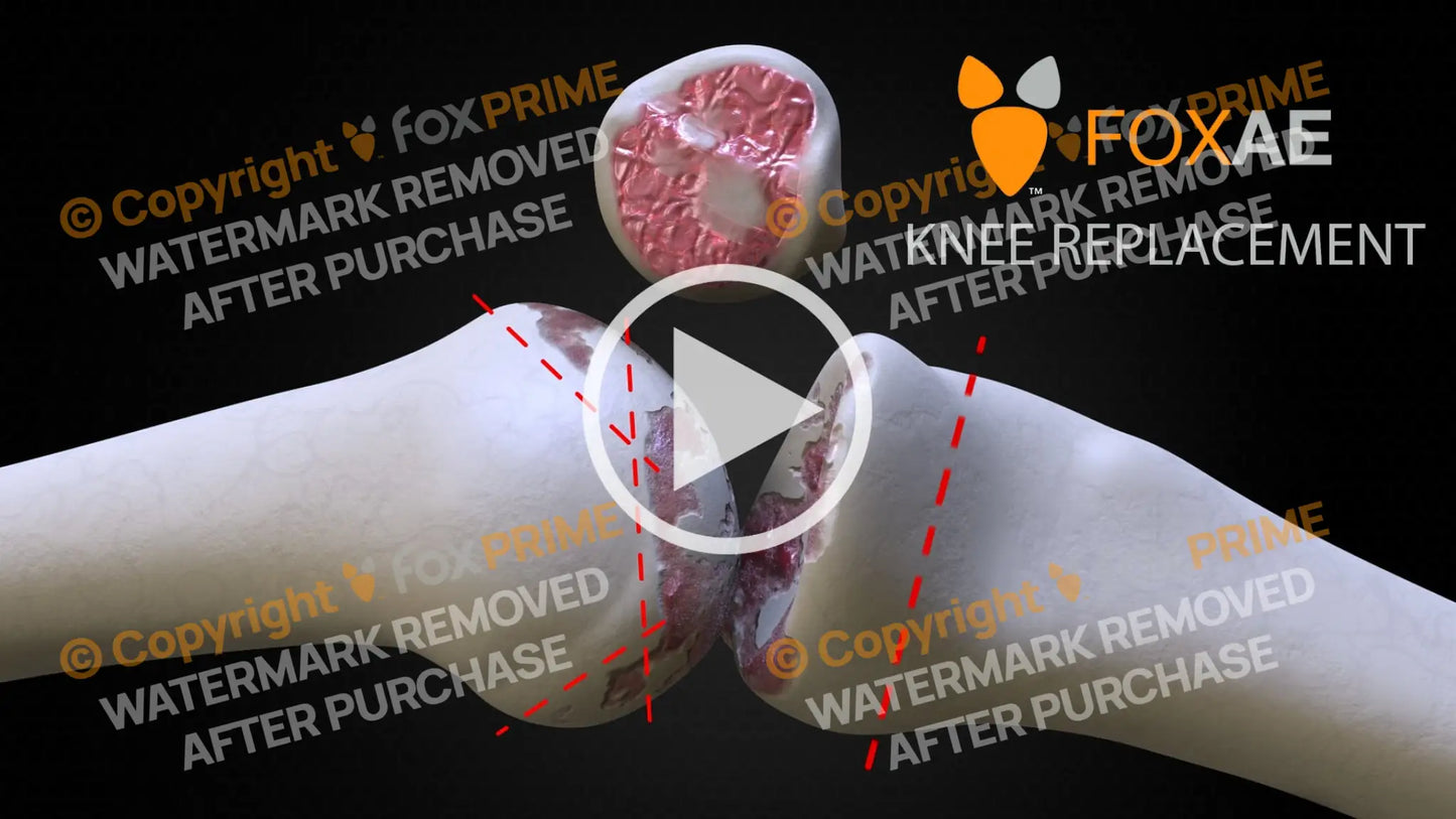 CUSTOM KNEE Knee Replacement. / Animation