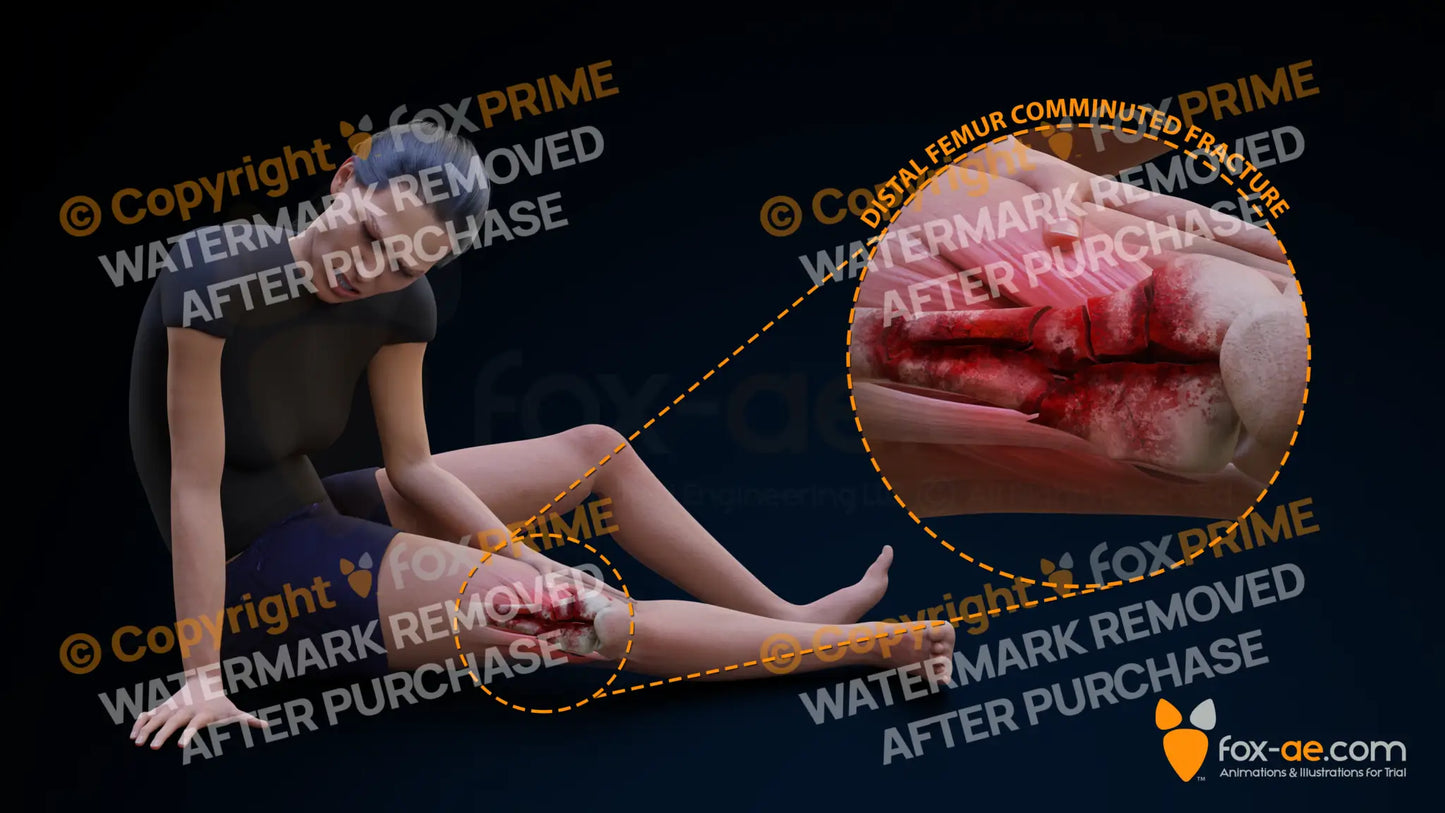 Distal Femur Right Comminuted Fracture Single Use / Female / Light Still Shot
