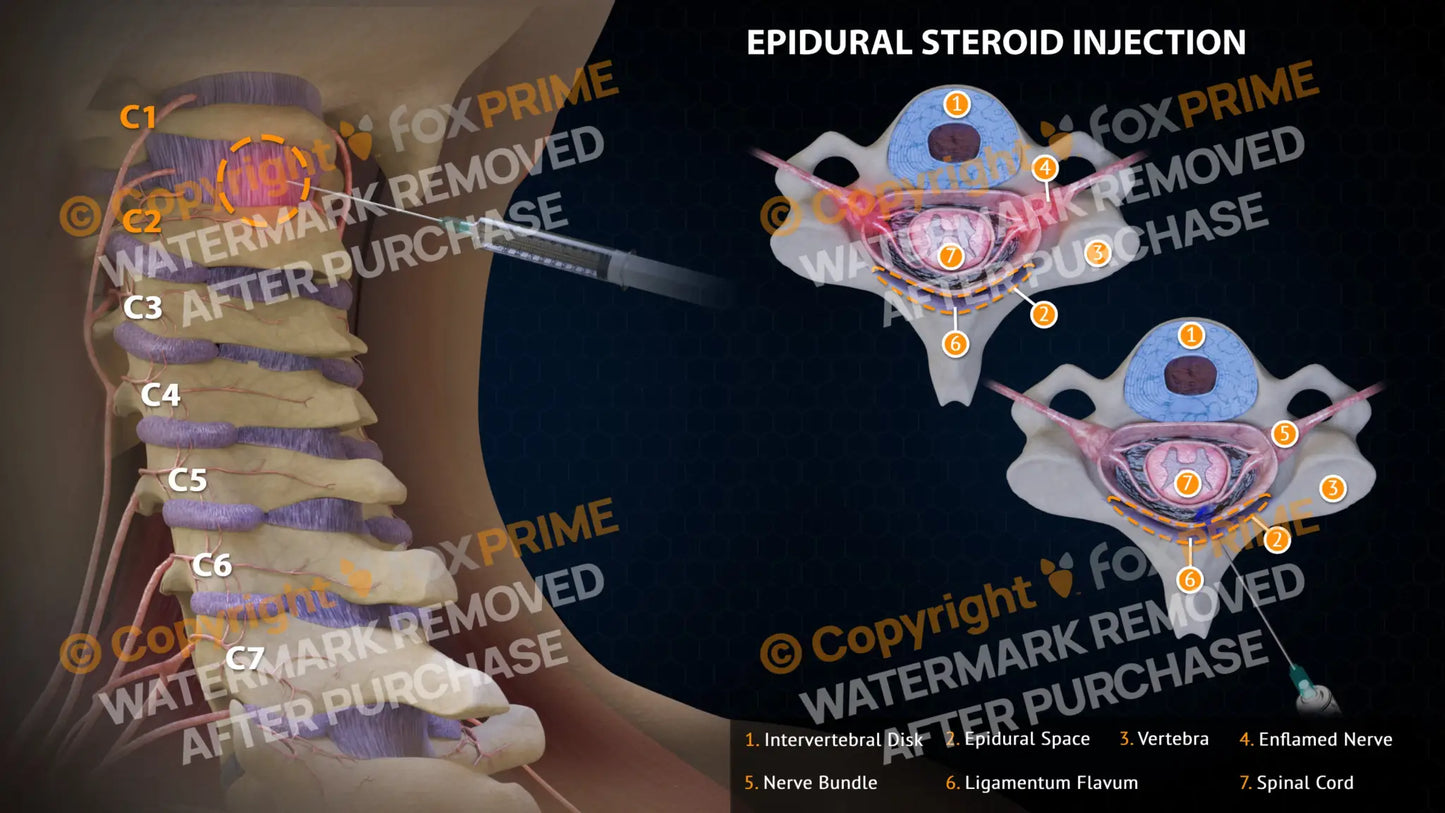 Epidural Steroid Injections Right C1-2 Single Use / Light Still Shot