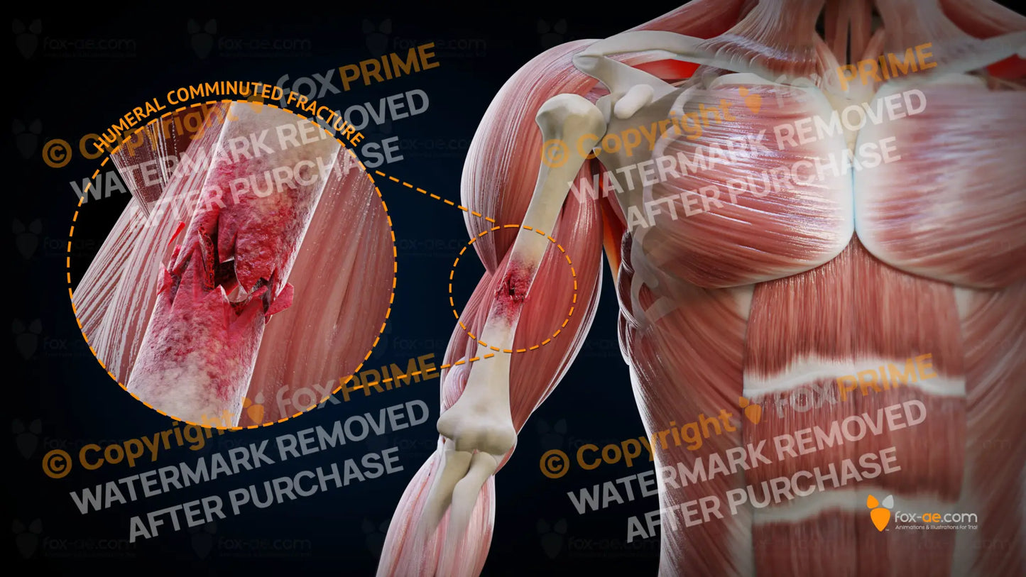 Humeral Comminuted Fracture Right Still Shot