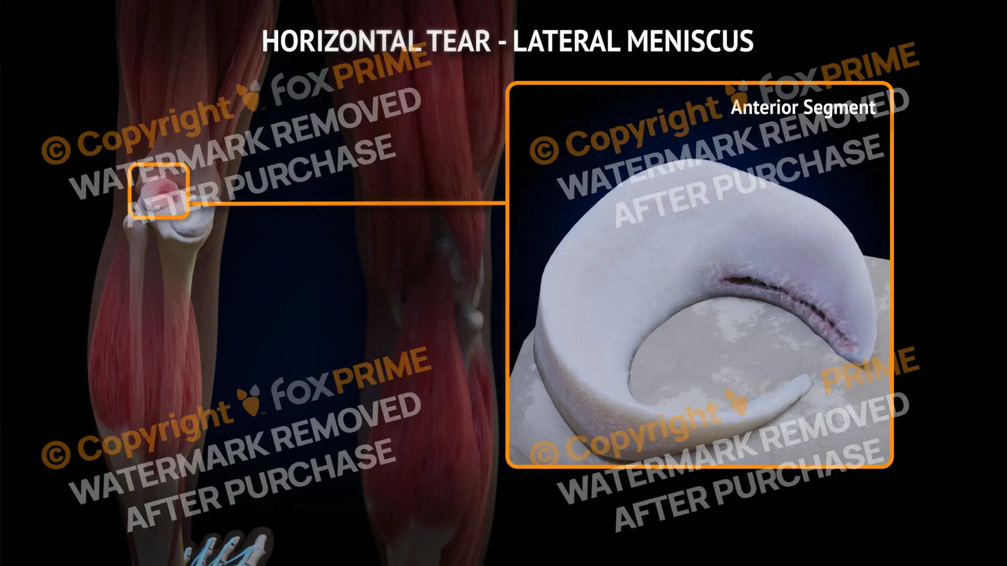 Lateral Meniscus Tear - Horizontal Left Leg Type 3 Still Shot