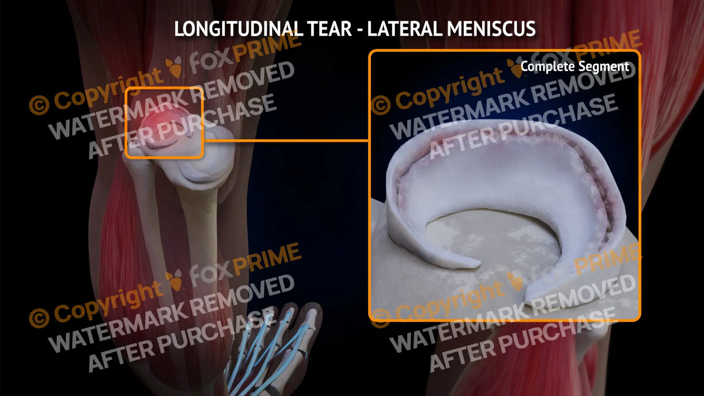 Lateral Meniscus Tear - Longitudinal Left Leg Type 1 Still Shot