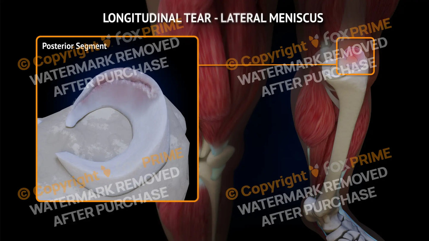 Lateral Meniscus Tear - Longitudinal Left Leg Type 3 Still Shot