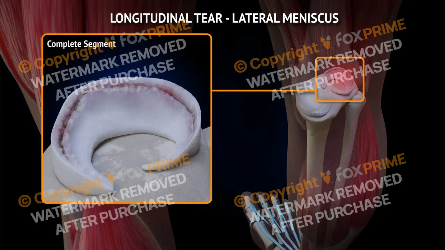 Lateral Meniscus Tear - Longitudinal Right Leg Type 1 Still Shot