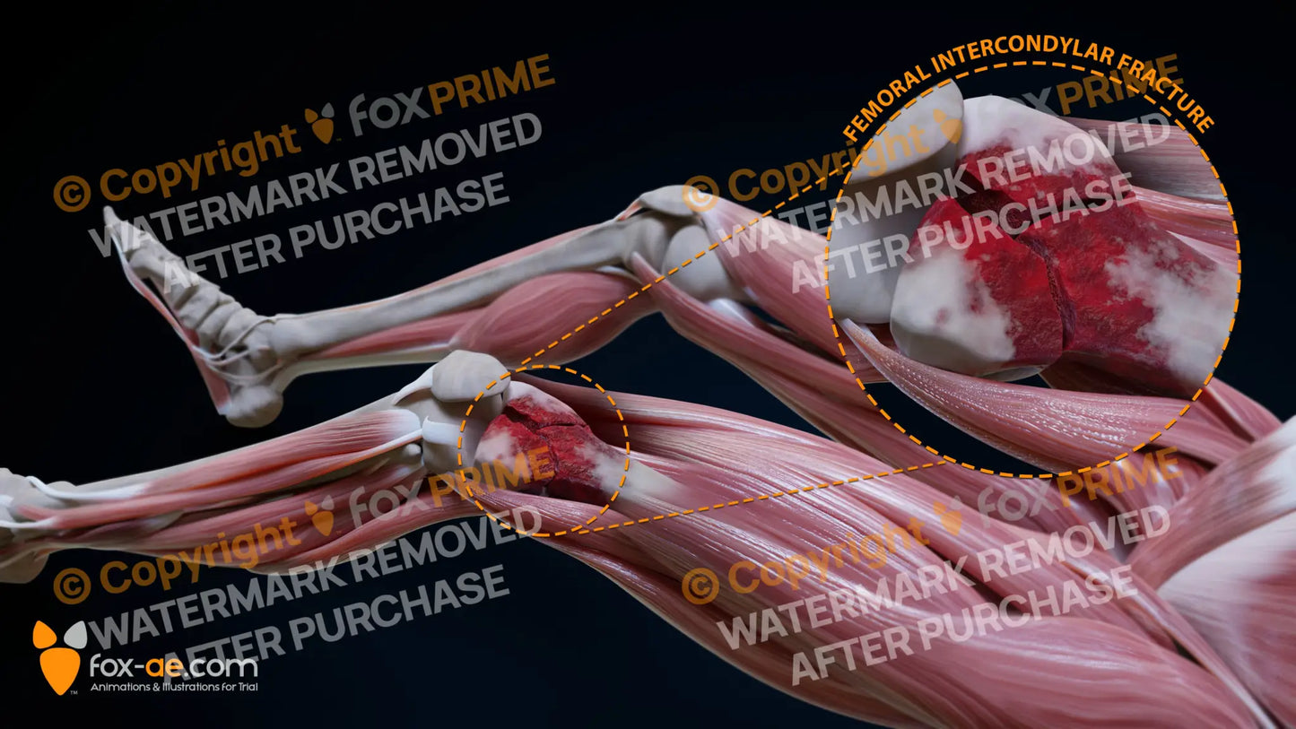 Left Femoral Intercondylar Fracture Still Shot