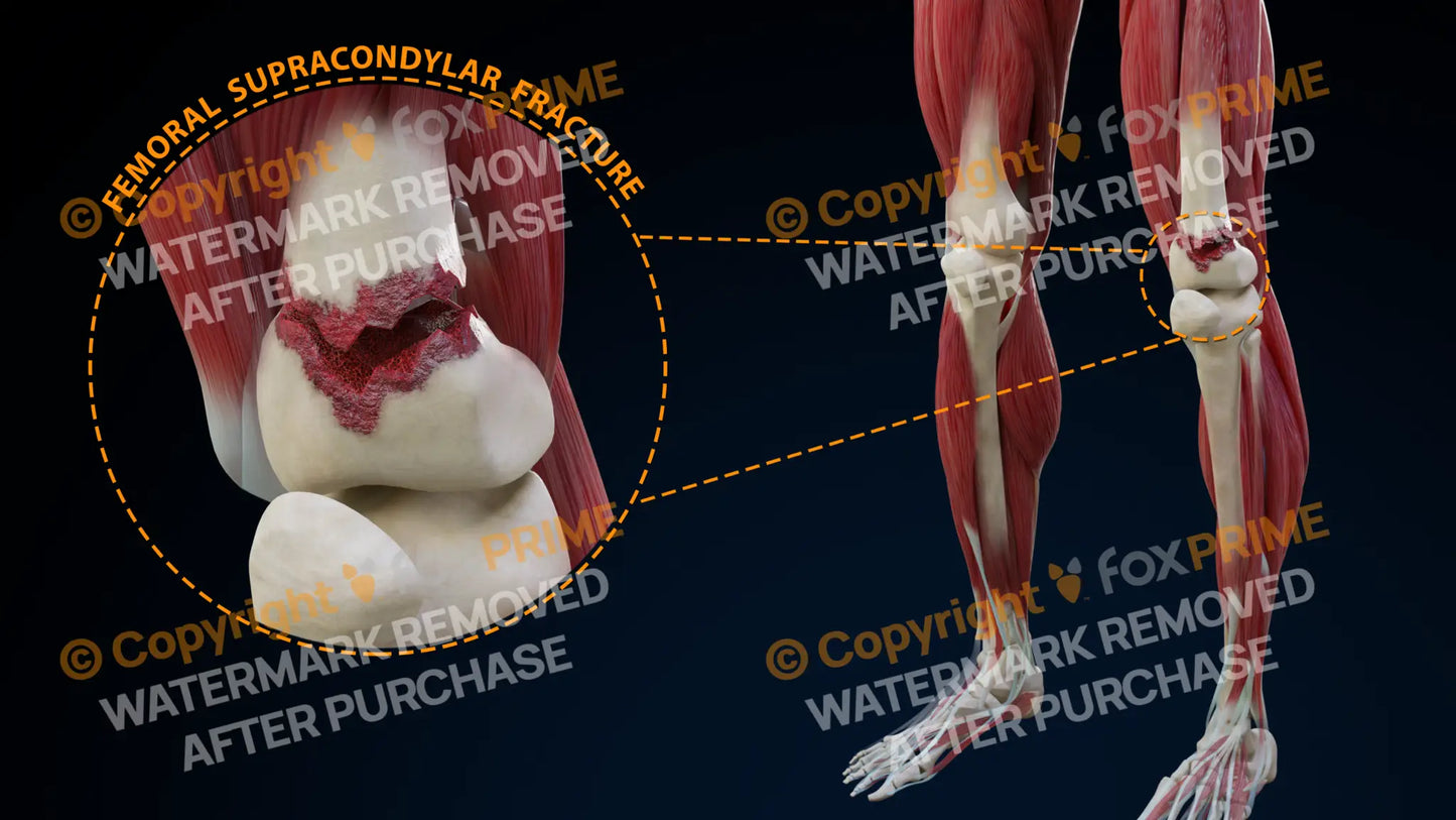 Left Femoral Supracondylar Fracture Still Shot