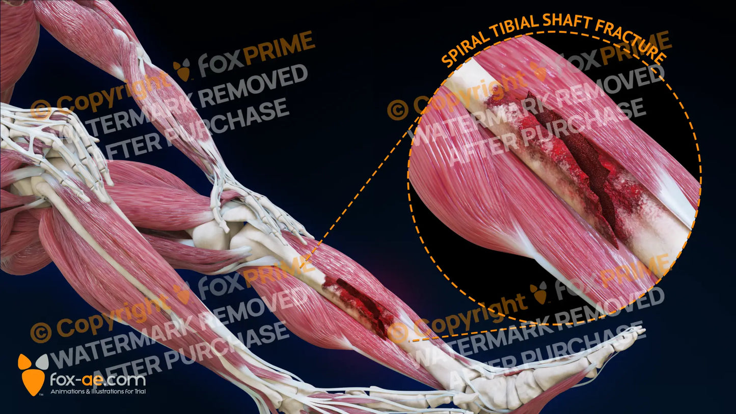 Left Spiral Tibial Shaft Fracture Still Shot