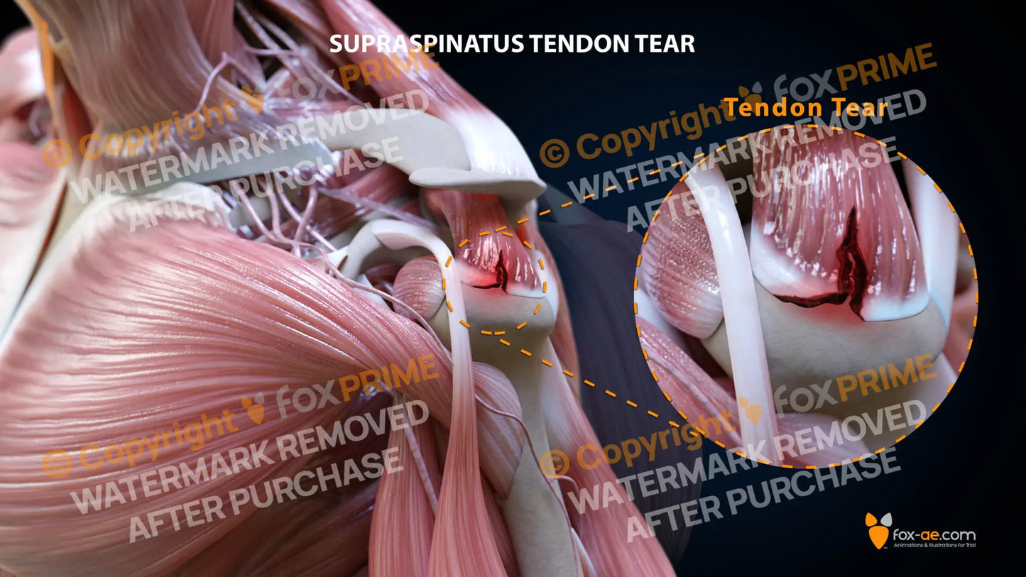 Left L Shape Tear Still Shot