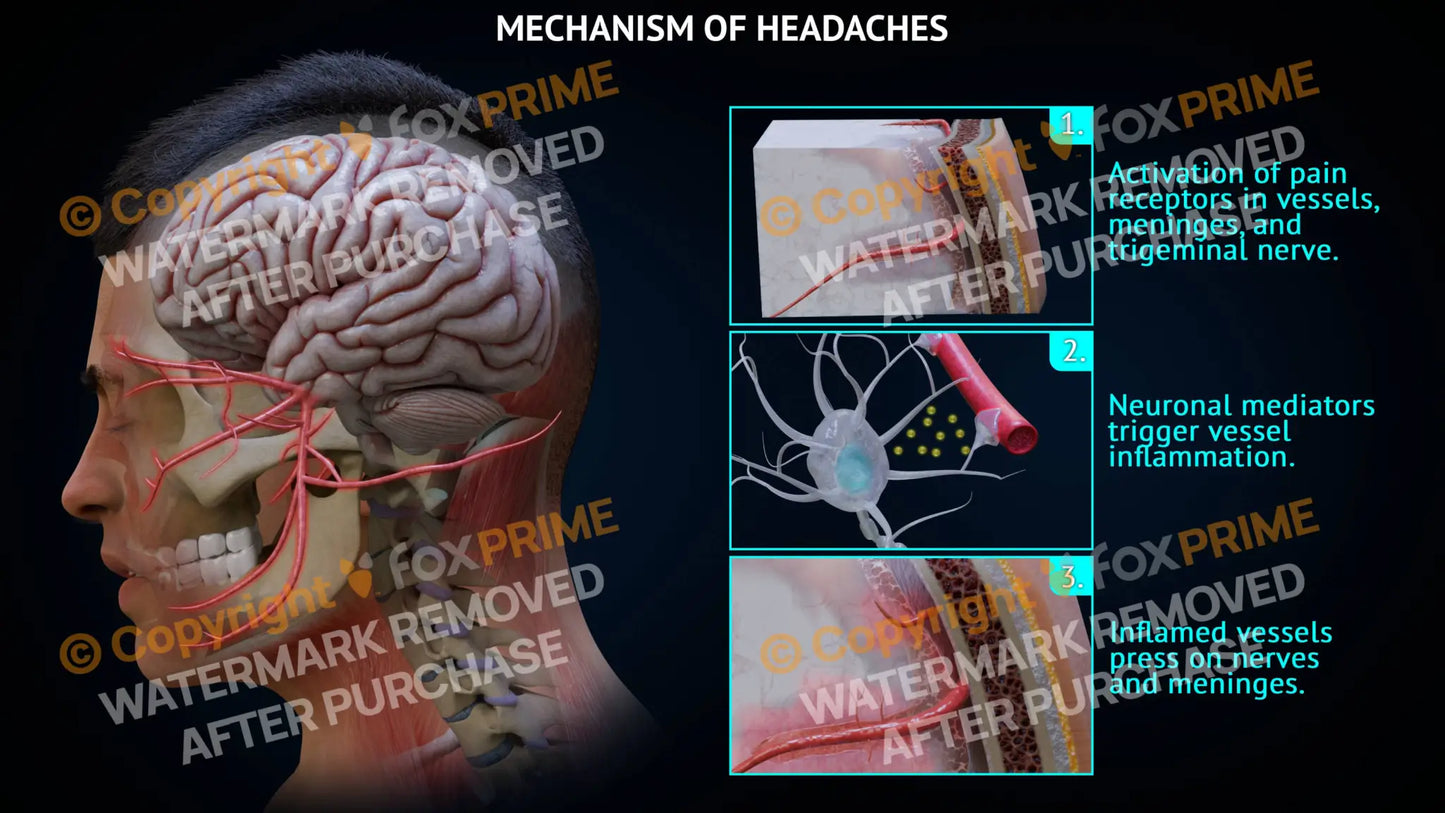 Mechanism of Headache Still Shot