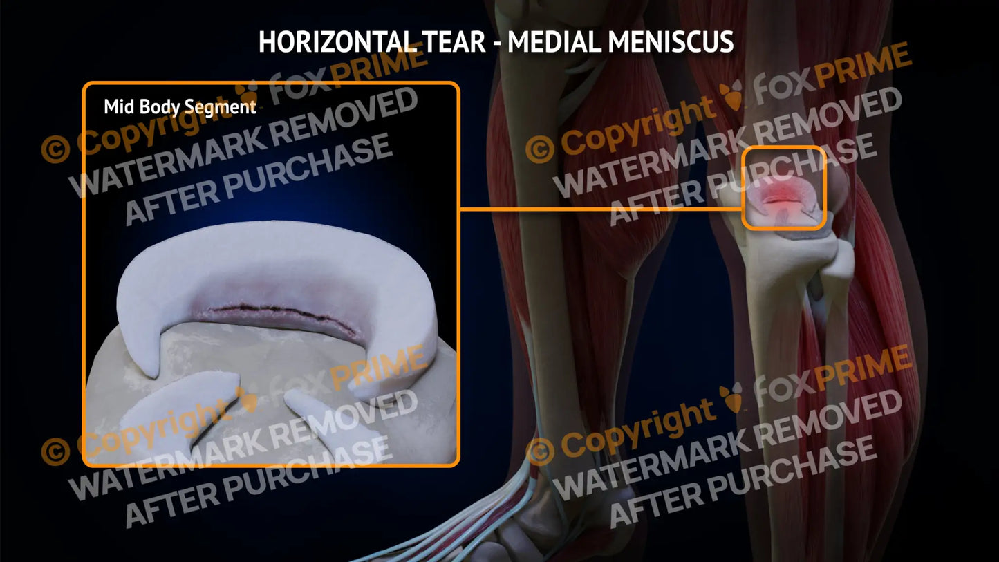 Medial Meniscus Tear - Horizontal Left Leg Type 1 Still Shot