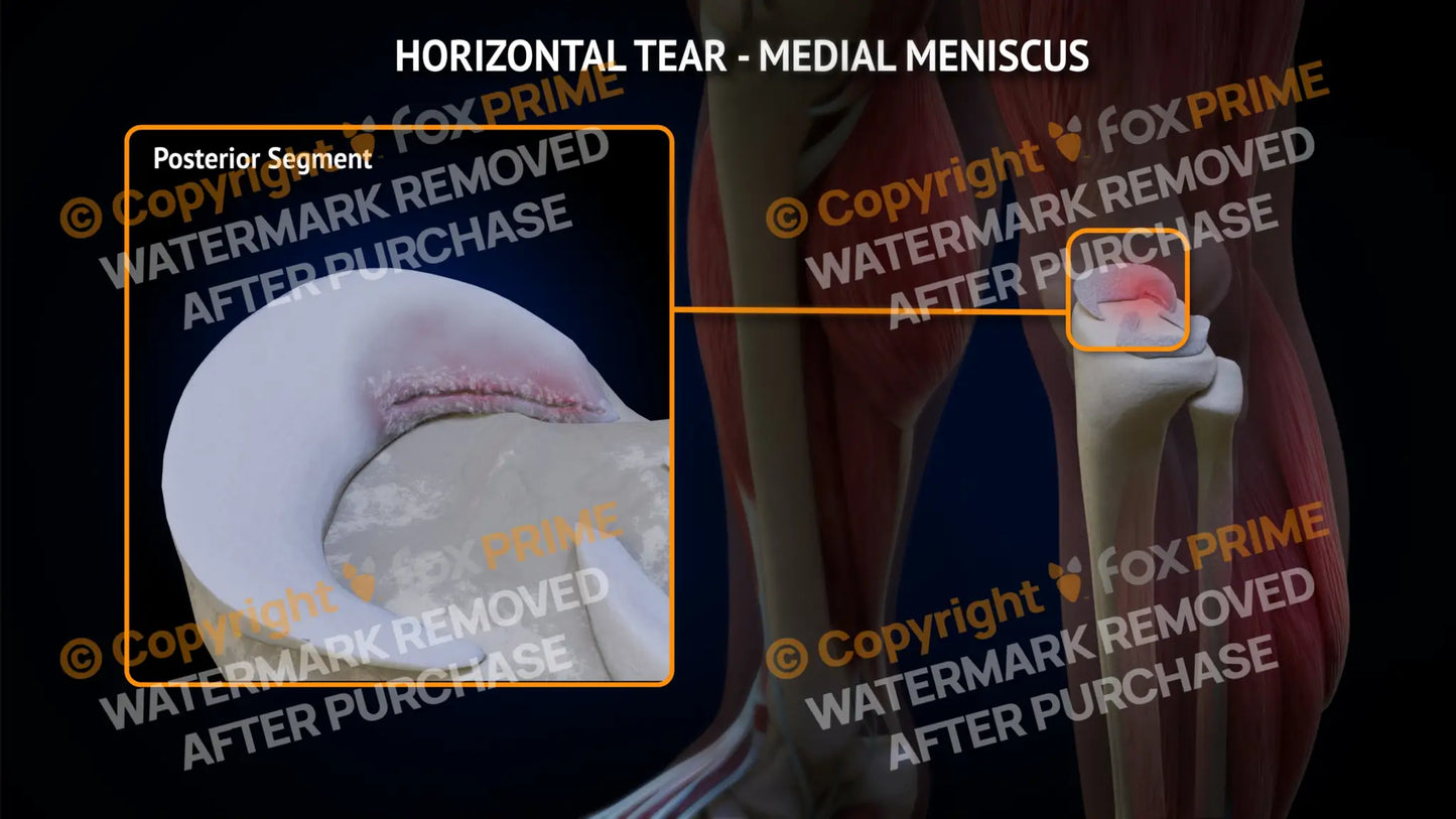 Medial Meniscus Tear - Horizontal Left Leg Type 3 Still Shot