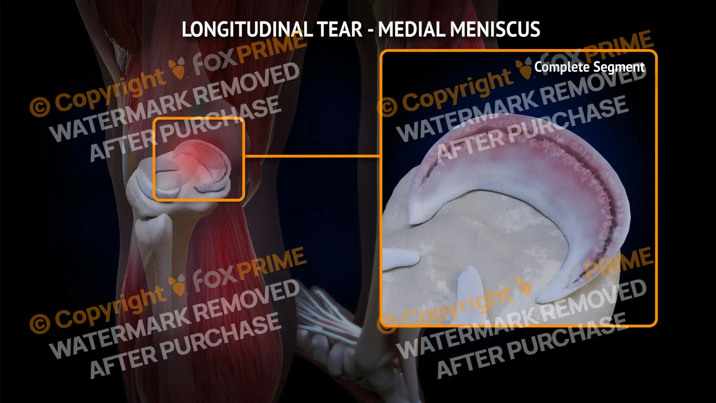 Medial Meniscus Tear - Longitudinal Left Leg Type 1 Still Shot