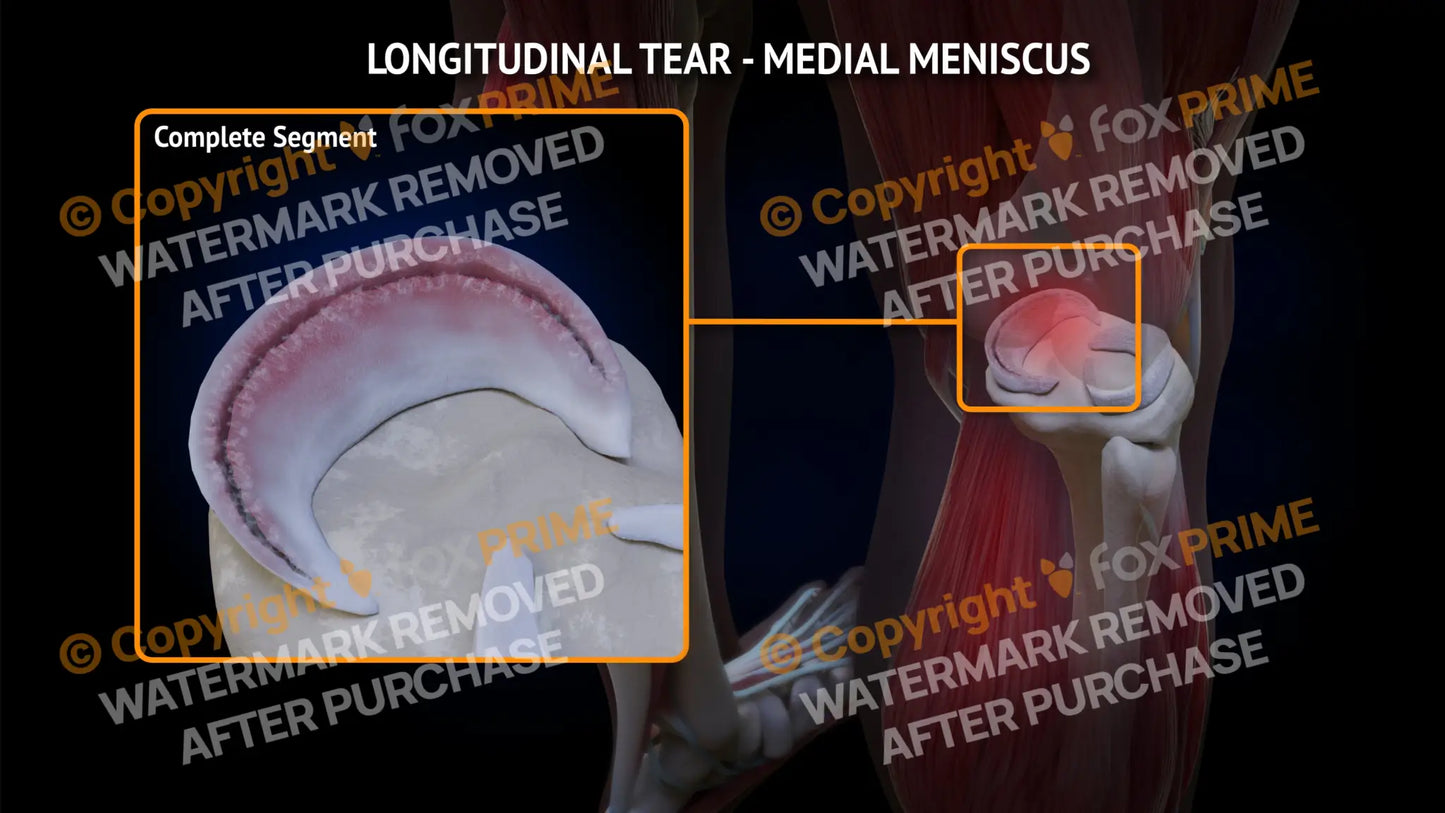 Medial Meniscus Tear - Longitudinal Right Leg Type 1 Still Shot