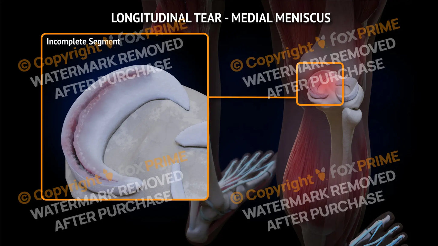 Medial Meniscus Tear - Longitudinal Right Leg Type 2 Still Shot