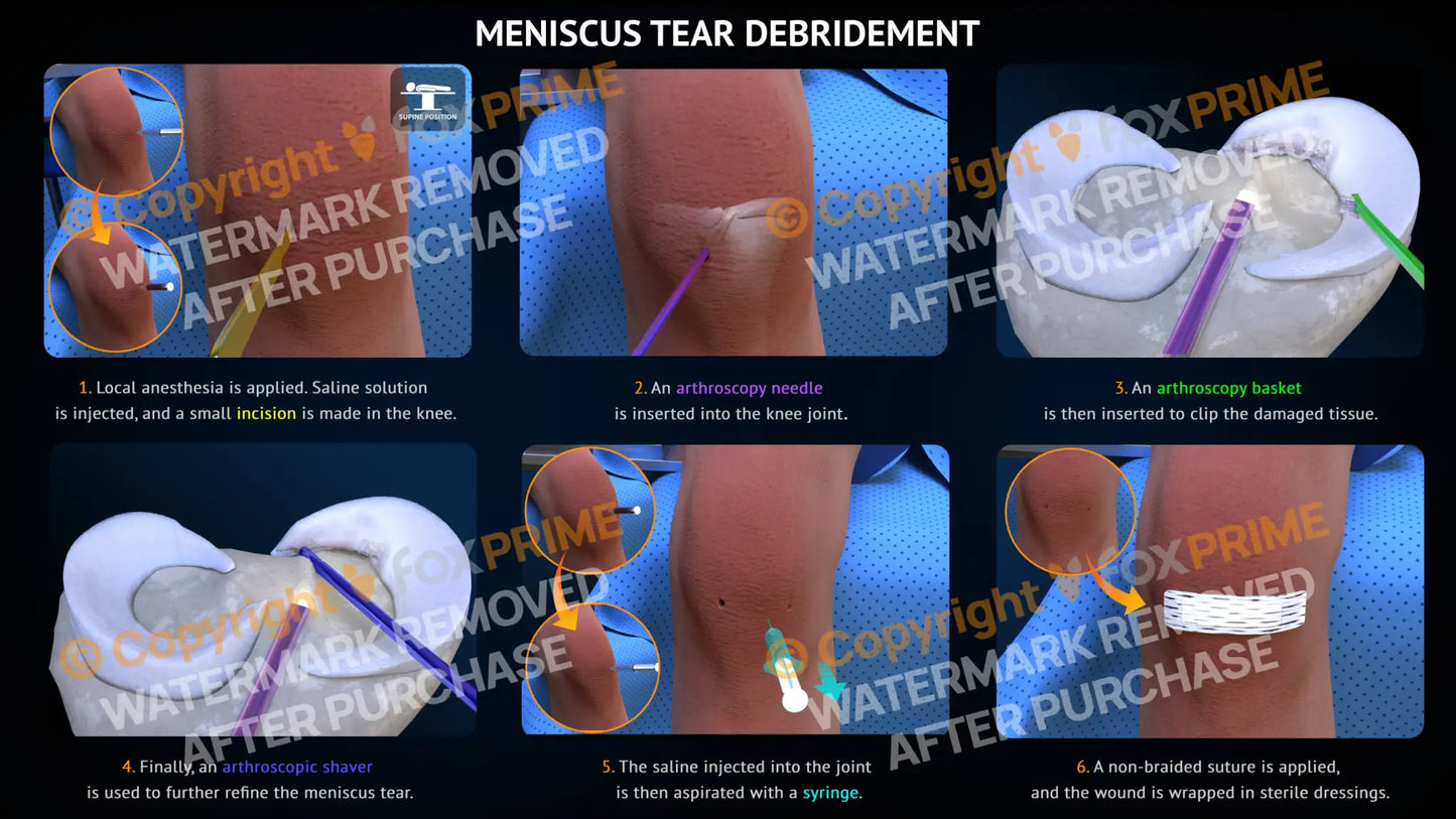 Meniscus Tear Debridement Surgery Single Use / Light Still Shot