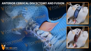 Anterior Cervical Discectomy and Fusion Right C6-C7 (Animation)