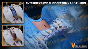 Anterior Cervical Discectomy and Fusion Left C2-C3 (Animation)