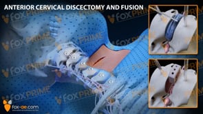 Anterior Cervical Discectomy and Fusion Right C2-C3 (Animation)