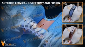 Anterior Cervical Discectomy and Fusion Right C3-C4 (Animation)