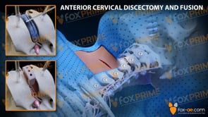 Anterior Cervical Discectomy and Fusion Left C3-C4 (Animation)