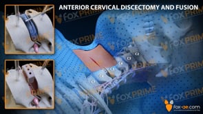 Anterior Cervical Discectomy and Fusion Left C5-C6 (Animation)