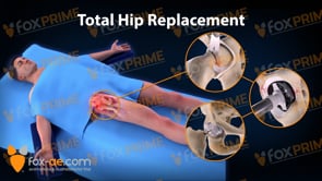 Total Hip Replacement Right (Animation)