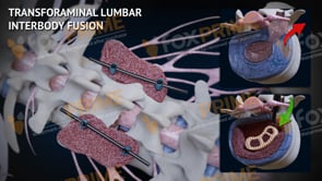 Transforaminal Lumbar Interbody Fusion L2-L3 (Animation)