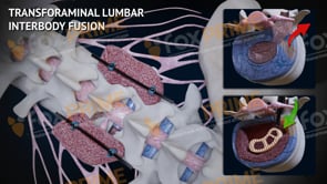 Transforaminal Lumbar Interbody Fusion L3-L4 (Animation)