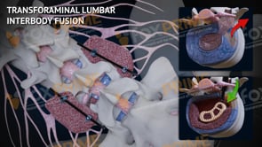 Transforaminal Lumbar Interbody Fusion L4-L5 (Animation)